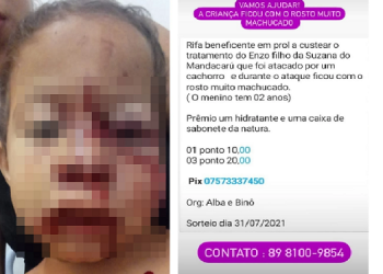 Criança fica com rosto desfigurado ao ser atacada por cão no Piauí